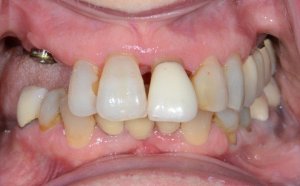 Patient with complex situation that required removal of her remaining upper teeth.