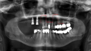 X-ray showing bone loss, failing bridges, dental decay and unrestored dental implants.