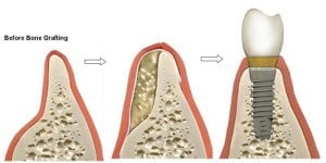 Before Bone Grafting Illustration, After Bone Grafting with Dental Implant Placed